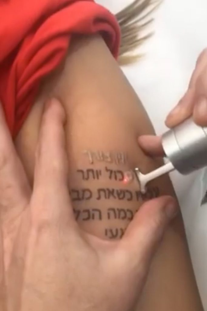הסרת קעקועים